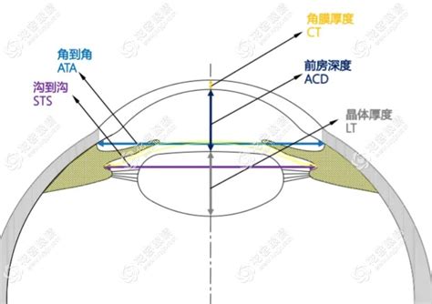 拱高|ICL植入术后拱高的预测及研究进展